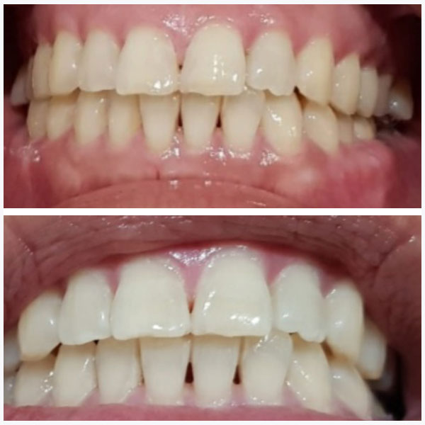 Led-teeth-whitening-before-after-3