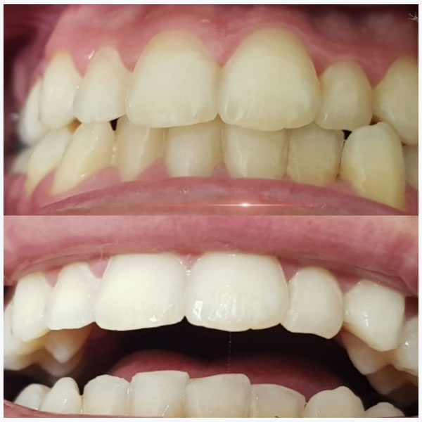 Led-teeth-whitening-before-after